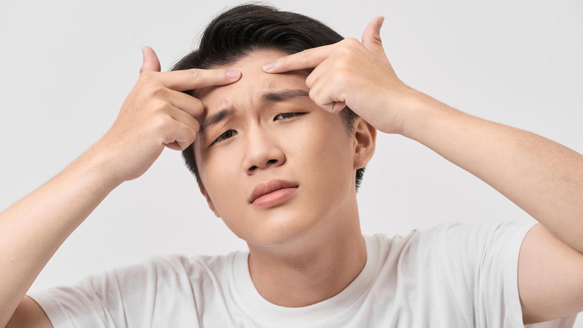 Kebiasaan yang Harus Dihindari untuk Kulit Dewasa yang Berjerawat