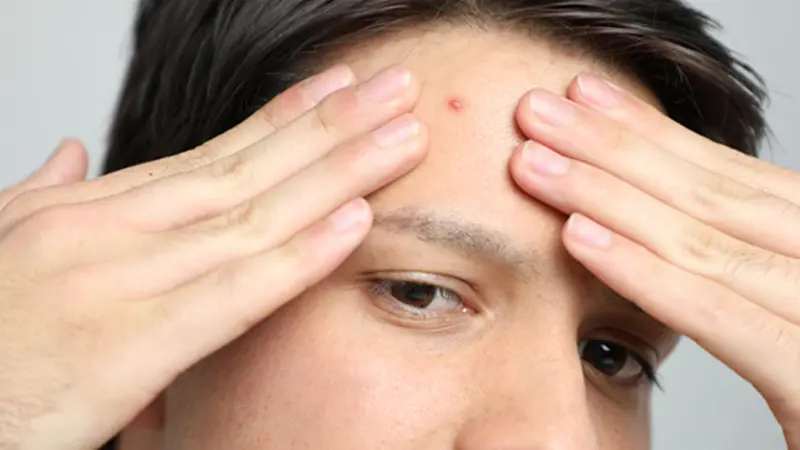 Kok Makin Dewasa Makin Banyak Jerawat? Ini Penjelasan Medisnya