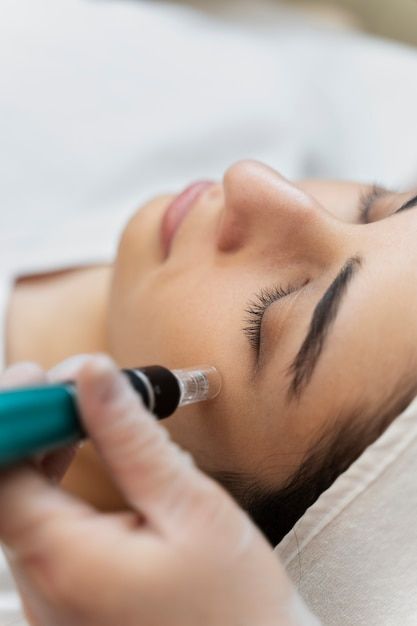 Microneedling untuk Bekas Jerawat: Teknologi, Manfaat & Keamanannya