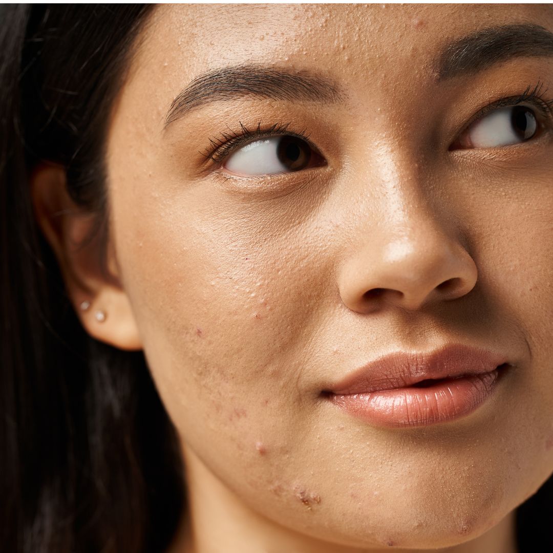 Jerawat di Kulit Berminyak: Cara Mengontrolnya