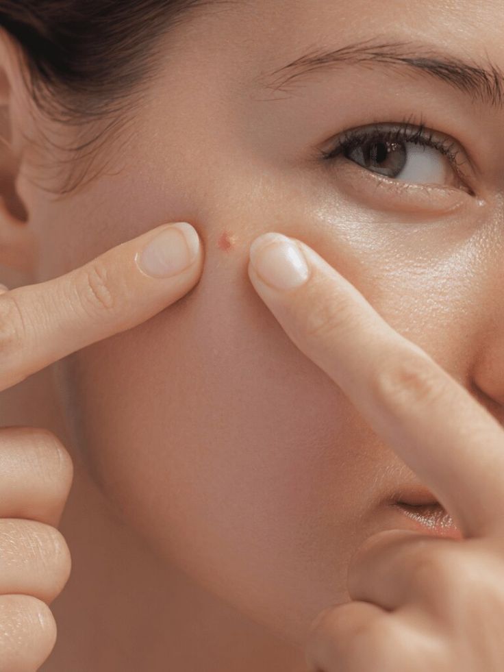 Mau Perawatan Jerawat? Begini Cara Pilih Klinik Kecantikan yang Aman