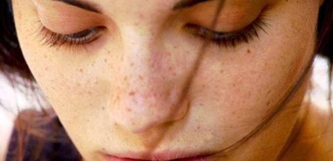 Perawatan Kecantikan Kulit yang Wajib Dicoba untuk Menghilangkan Flek Hitam