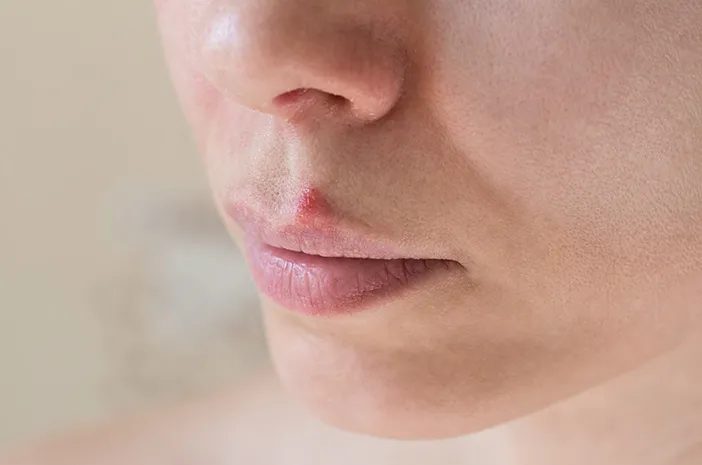 Komedo di Bibir? Ini Cara Tepat Mengatasinya!