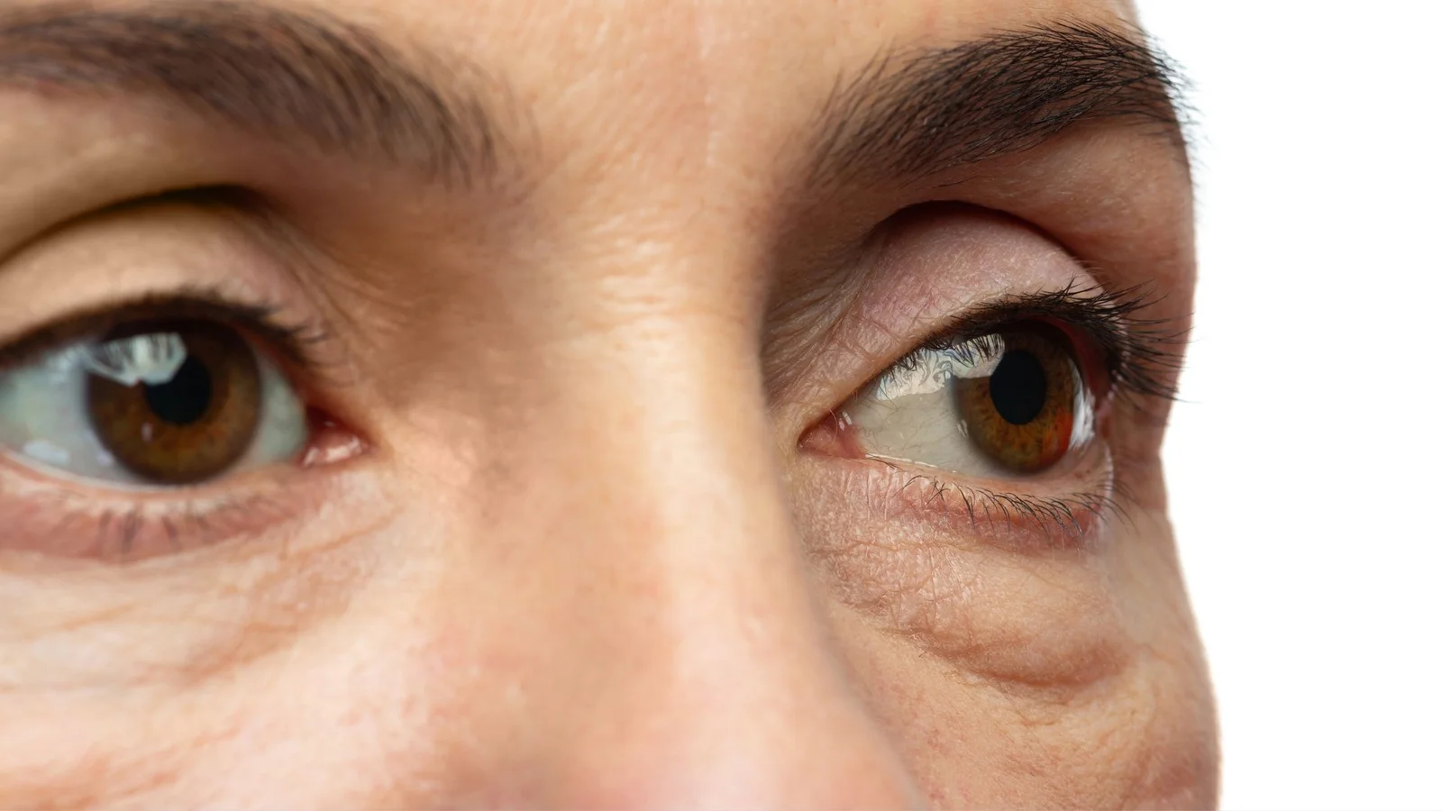 Kantung Mata Kendur dan Menghitam: Penyebab, Risiko, dan Perawatan Efektif