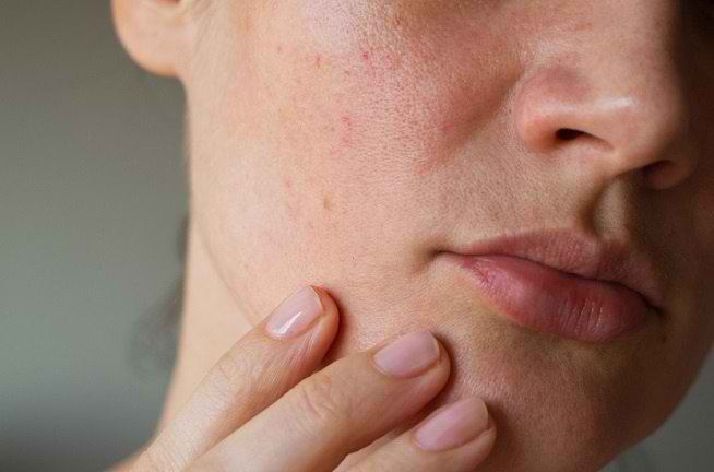 Kulit Sering Merah dan Perih? Begini Cara Membedakan Kulit Sensitif, Rosacea, dan Inflamasi