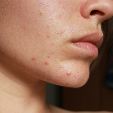 Dari Jerawat hingga Kulit Kusam: Solusinya ada di Reglow Klinik